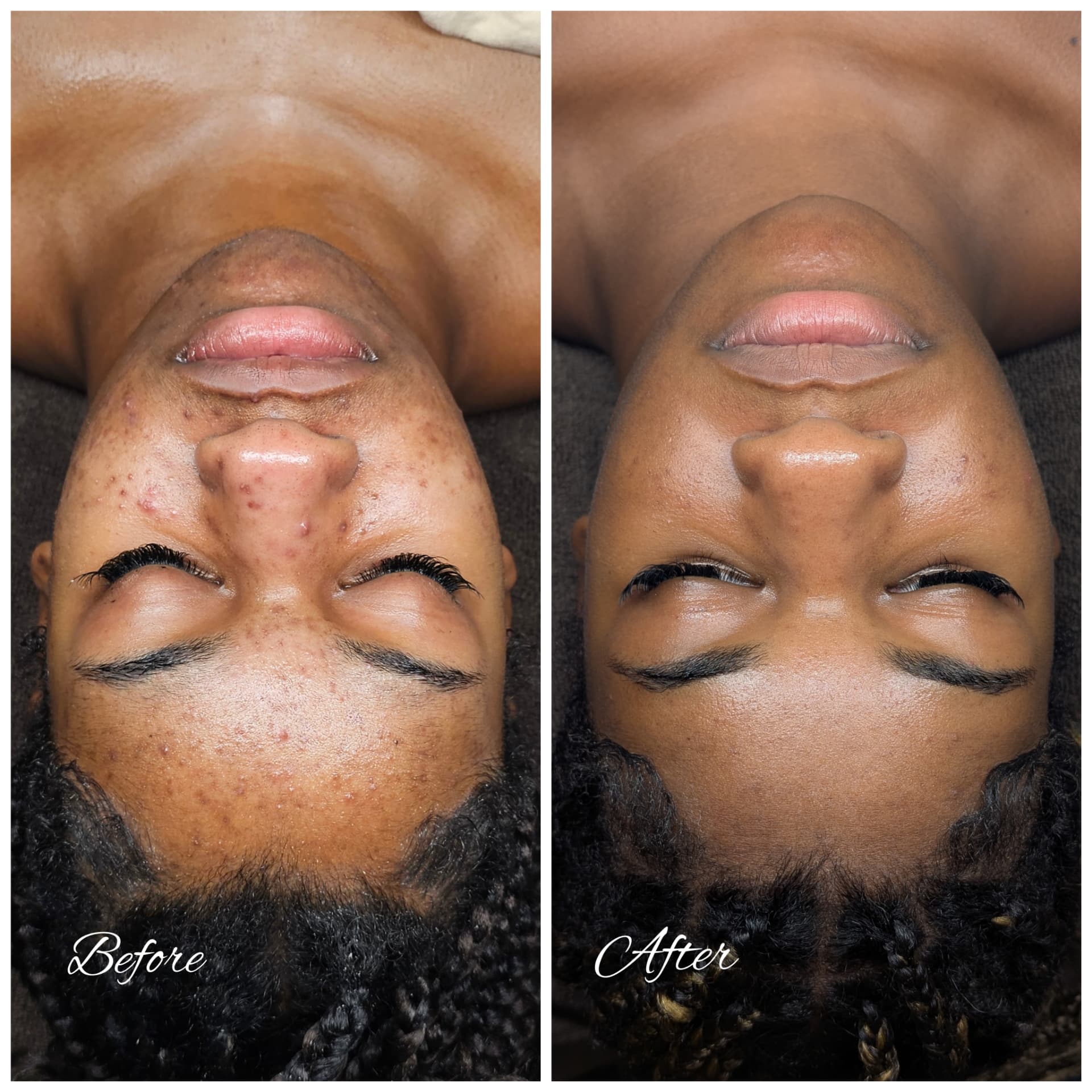 Client complexion and acne progress shown from the front before and after treatment